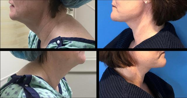 Neck Lift result at Stanwix Plastic Surgery in Richmond, VA