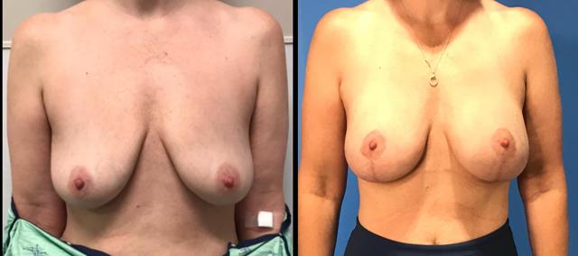 Breast Augmentation result at Stanwix Plastic Surgery in Richmond, VA