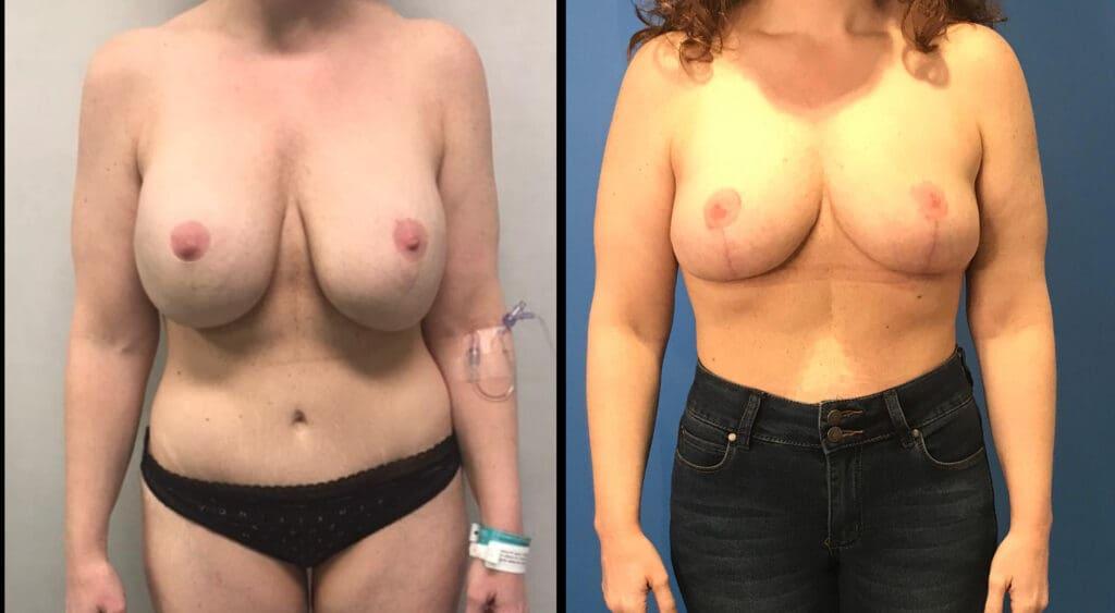 Stanwix Plastic Surgery breast lift result — Henrico, VA