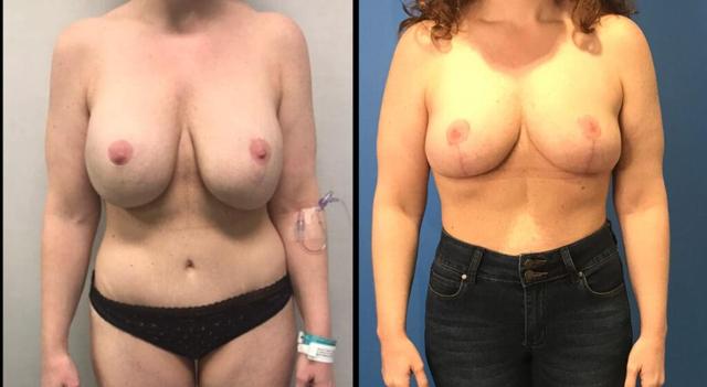 Breast Lift result at Stanwix Plastic Surgery in Richmond, VA