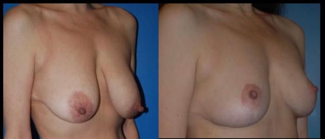 Breast Reduction result at Stanwix Plastic Surgery in Richmond, VA