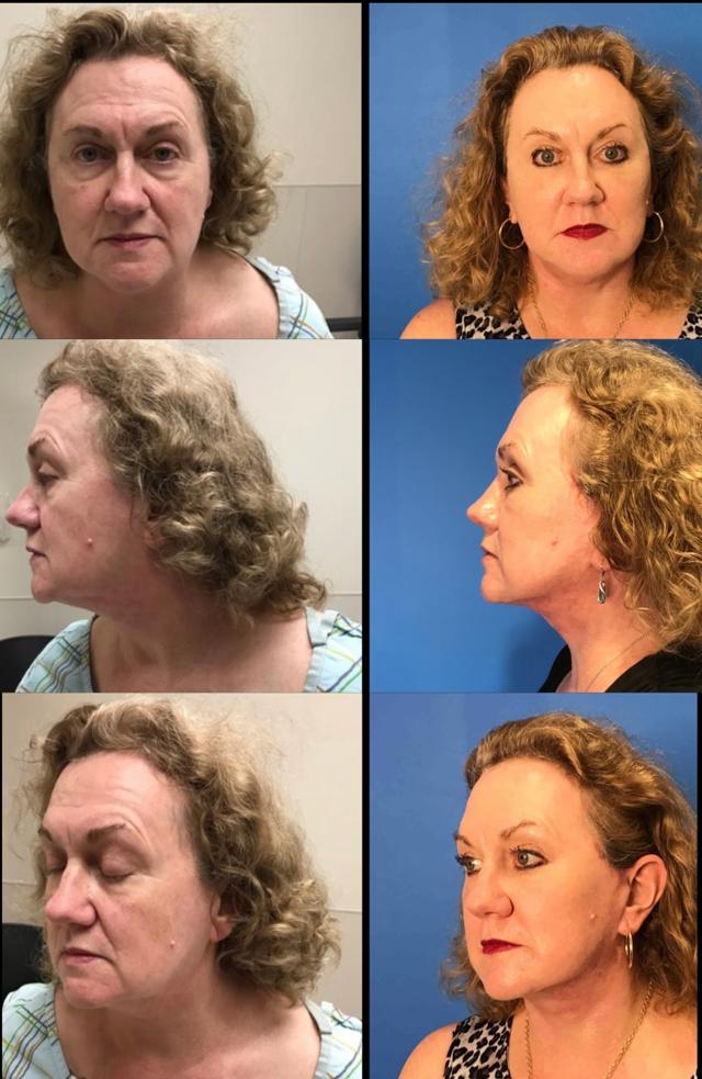 Neck Lift result at Stanwix Plastic Surgery in Richmond, VA