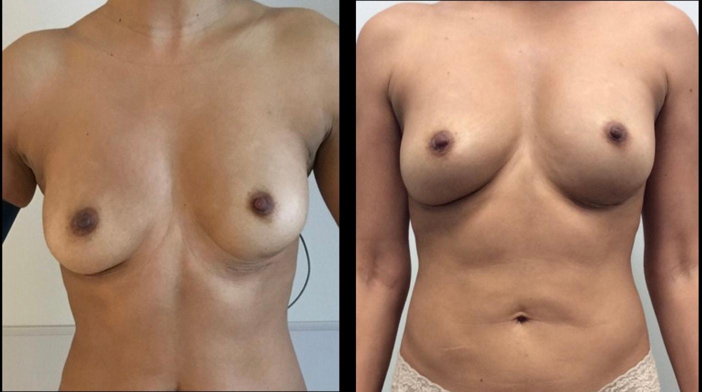 Stanwix Plastic Surgery breast fat transfer result — Richmond, VA