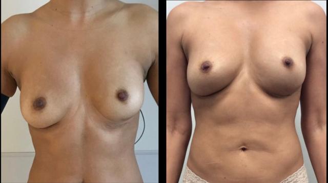 Breast Lift result at Stanwix Plastic Surgery in Richmond, VA