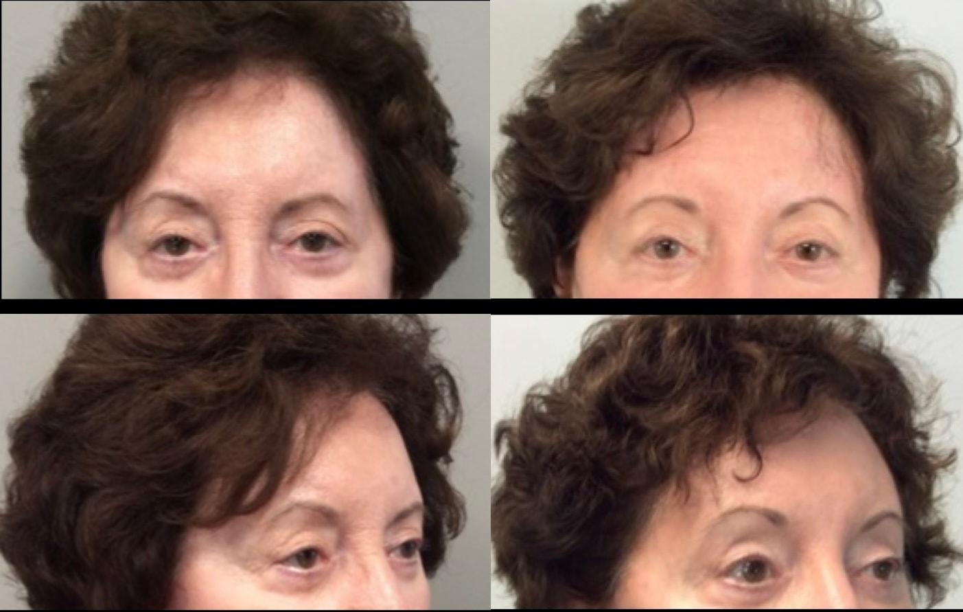 Stanwix Plastic Surgery brow lift result — Richmond, VA