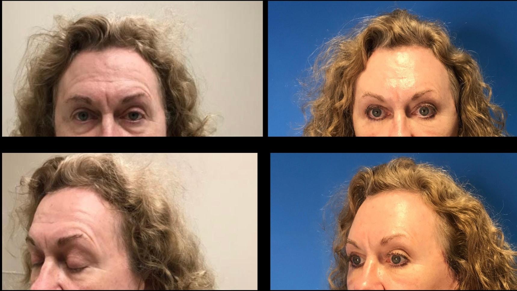 Stanwix Plastic Surgery brow lift result — Richmond, VA
