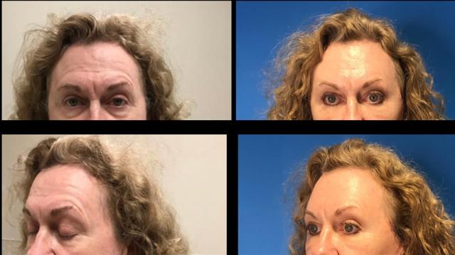 Brow Lift result at Stanwix Plastic Surgery in Richmond, VA