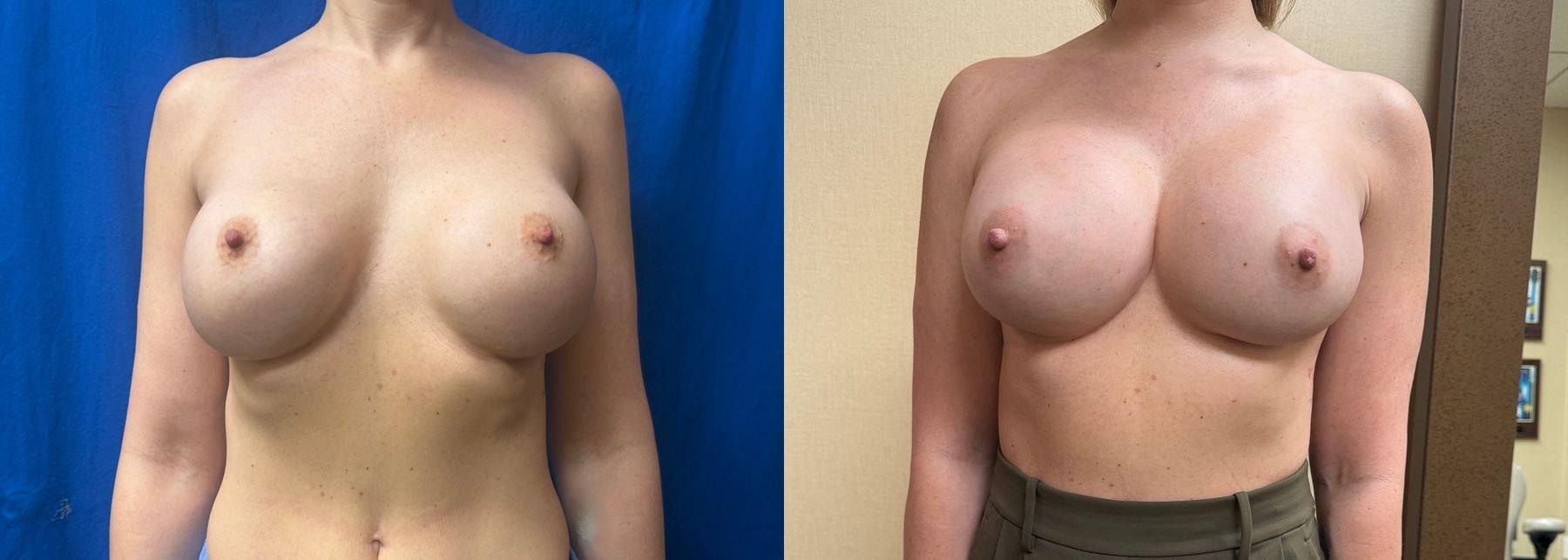 Delaware Valley Plastic Surgery breast augmentation revision result — Cherry Hill Township, NJ
