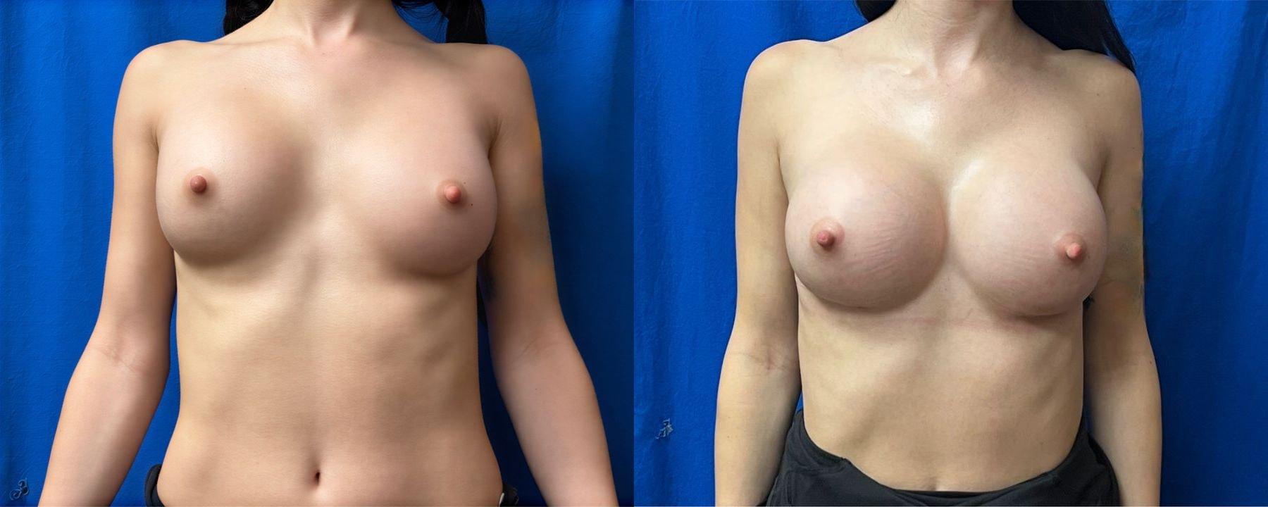 Delaware Valley Plastic Surgery breast augmentation revision result — Cherry Hill Township, NJ