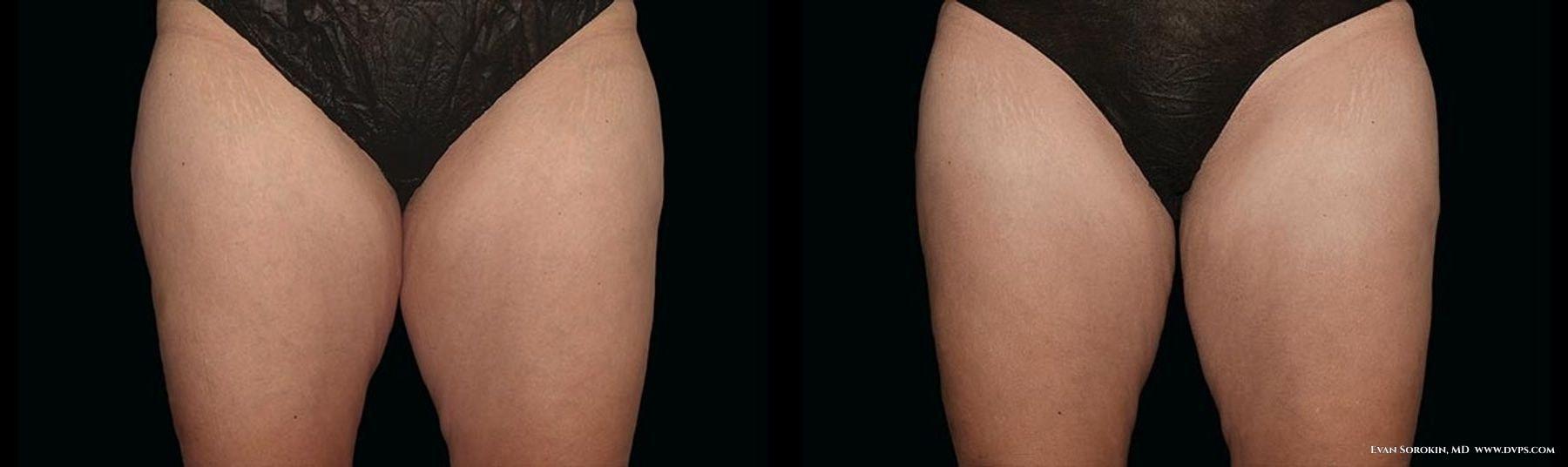 Delaware Valley Plastic Surgery fat freezing result — Cherry Hill Township, NJ
