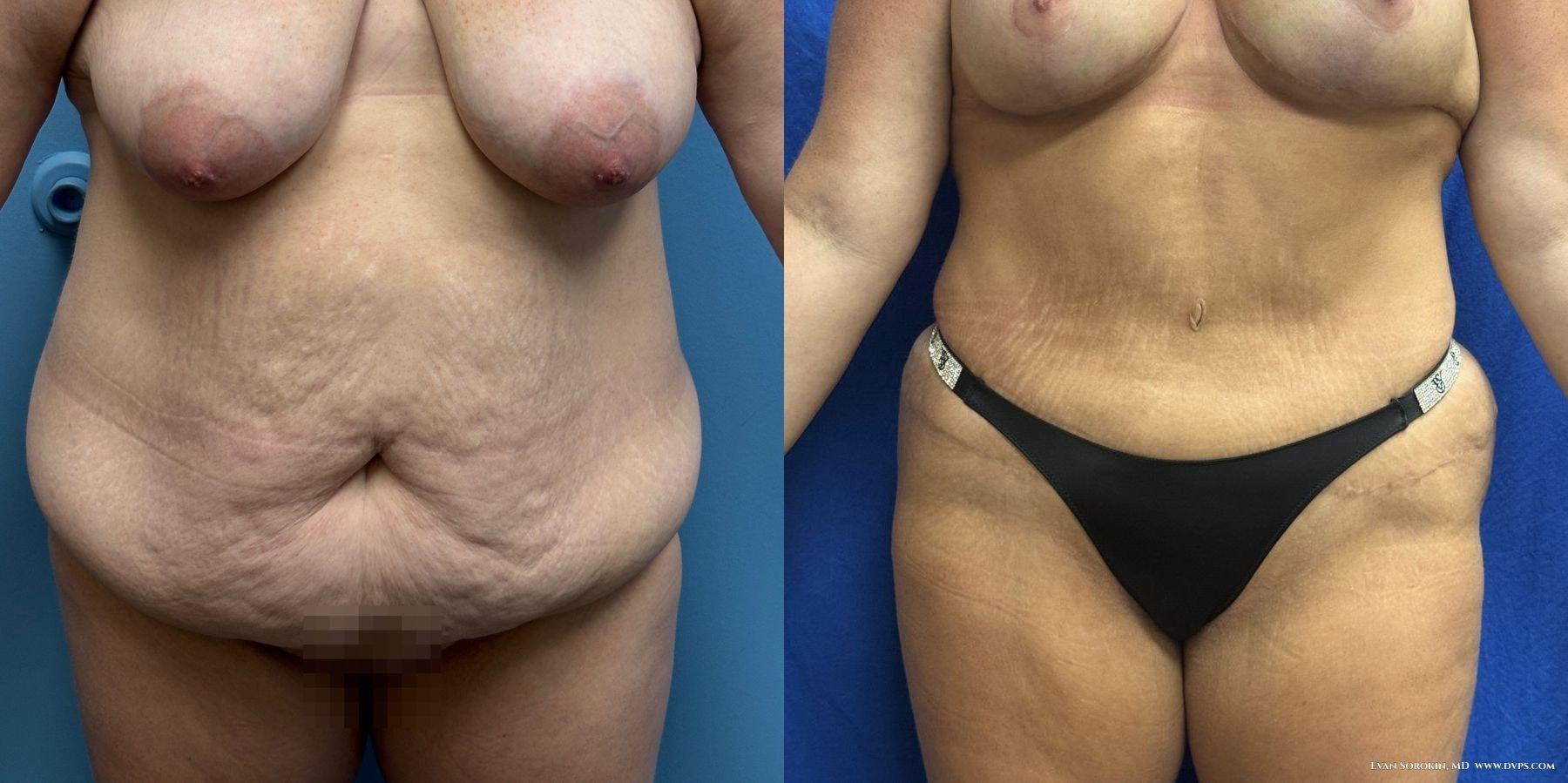 Delaware Valley Plastic Surgery tummy tuck result — Cherry Hill Township, NJ