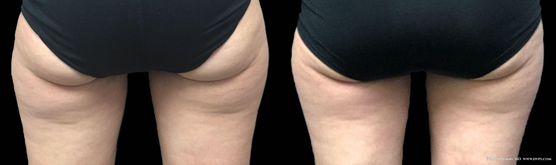 Delaware Valley Plastic Surgery fat freezing result — Cherry Hill Township, NJ
