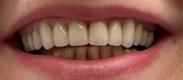Smile Makeover after at Tru Plano Dental in Plano, TX