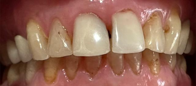Smile Makeover before at Tru Plano Dental in Plano, TX