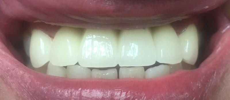 Tru Plano Dental smile makeover after — Plano, TX