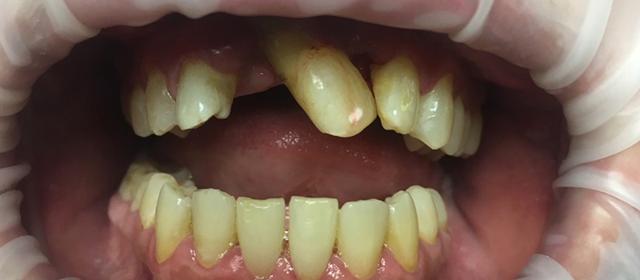 Smile Makeover before at Tru Plano Dental in Plano, TX
