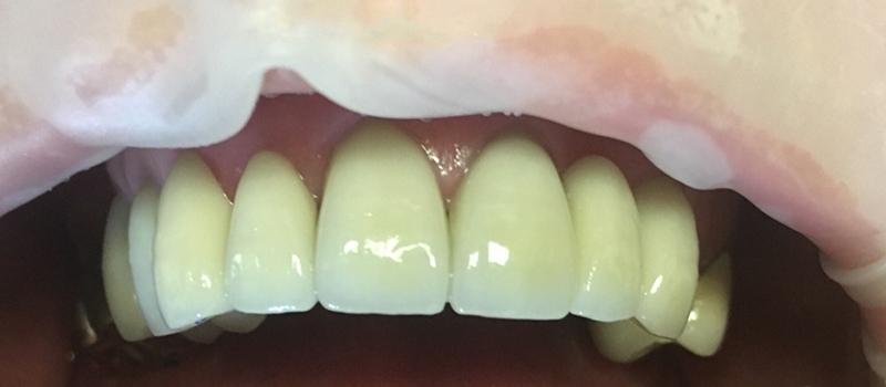 Tru Plano Dental smile makeover after — Plano, TX
