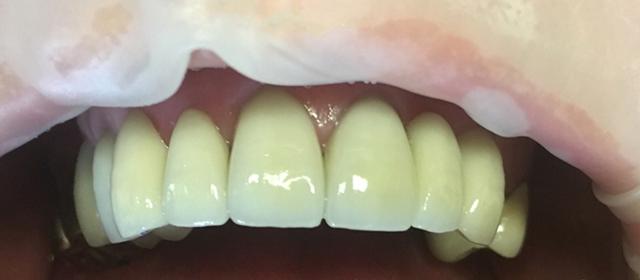 Smile Makeover after at Tru Plano Dental in Plano, TX