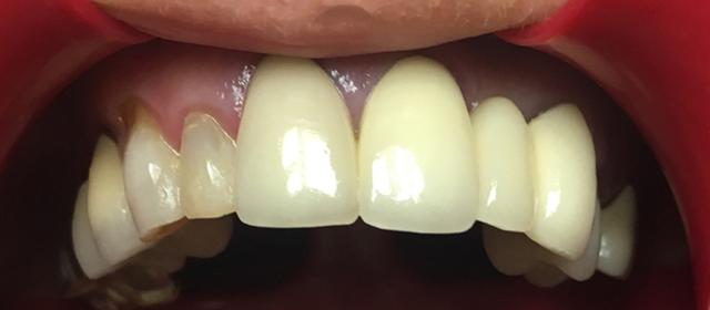 Smile Makeover before at Tru Plano Dental in Plano, TX