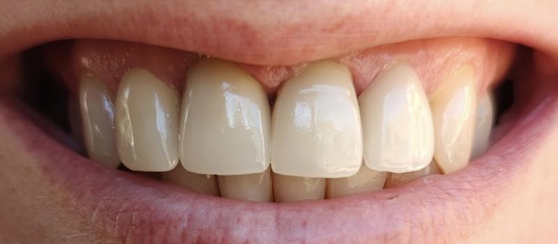 Tru Plano Dental smile makeover after — Plano, TX
