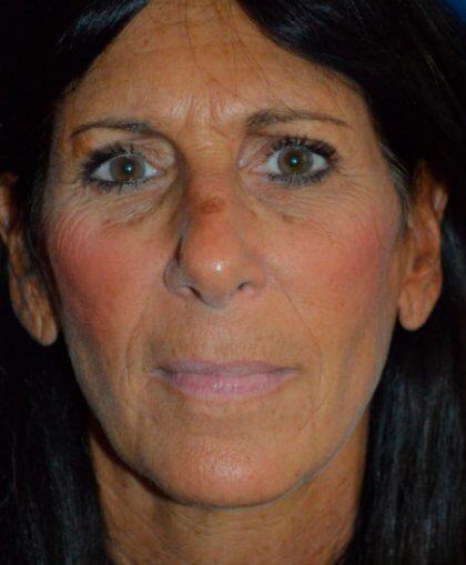 Brow Lift before at Optimization Centre (Gregory Albert, MD) in Boca Raton, FL