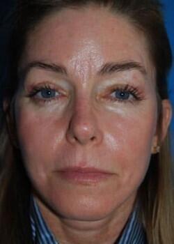 Optimization Centre (Gregory Albert, MD) brow lift after — Boca Raton, FL