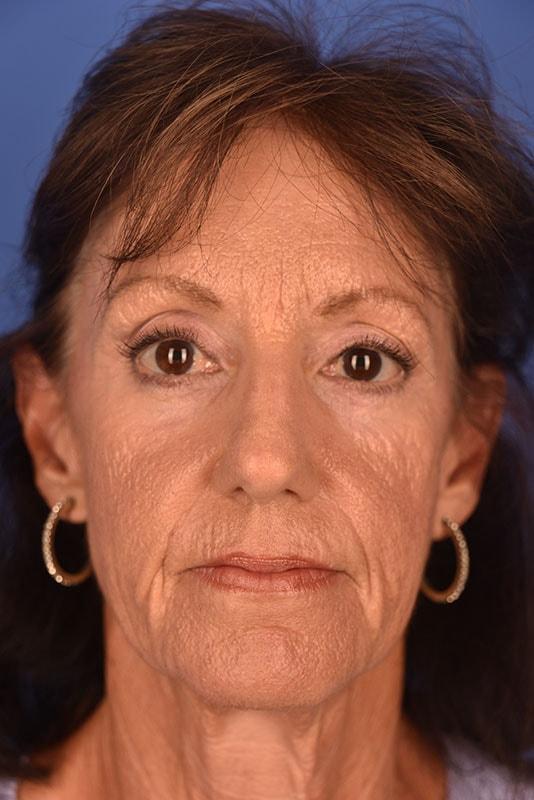 Optimization Centre (Gregory Albert, MD) brow lift after — Boca Raton, FL