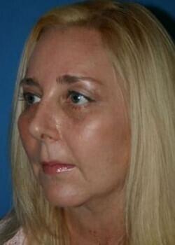 Optimization Centre (Gregory Albert, MD) chin implant after — Boca Raton, FL