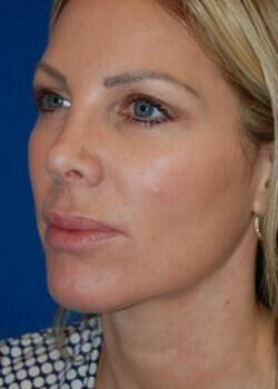 Optimization Centre (Gregory Albert, MD) cheek implant after — Boca Raton, FL