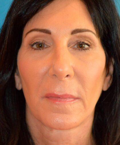 Brow Lift after at Optimization Centre (Gregory Albert, MD) in Boca Raton, FL