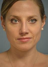Providence Facial Plastic and Cosmetic Surgery rhinoplasty after — Concordville, PA