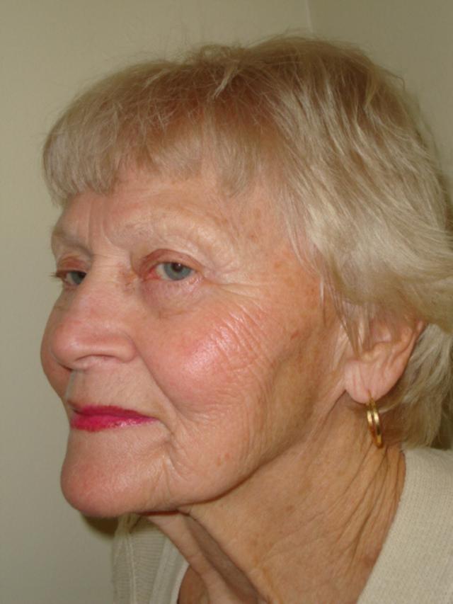 Laser Skin Resurfacing before at Providence Facial Plastic and Cosmetic Surgery in Concordville, PA