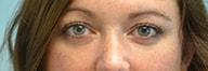 Providence Facial Plastic and Cosmetic Surgery eyelid lift after — Concordville, PA
