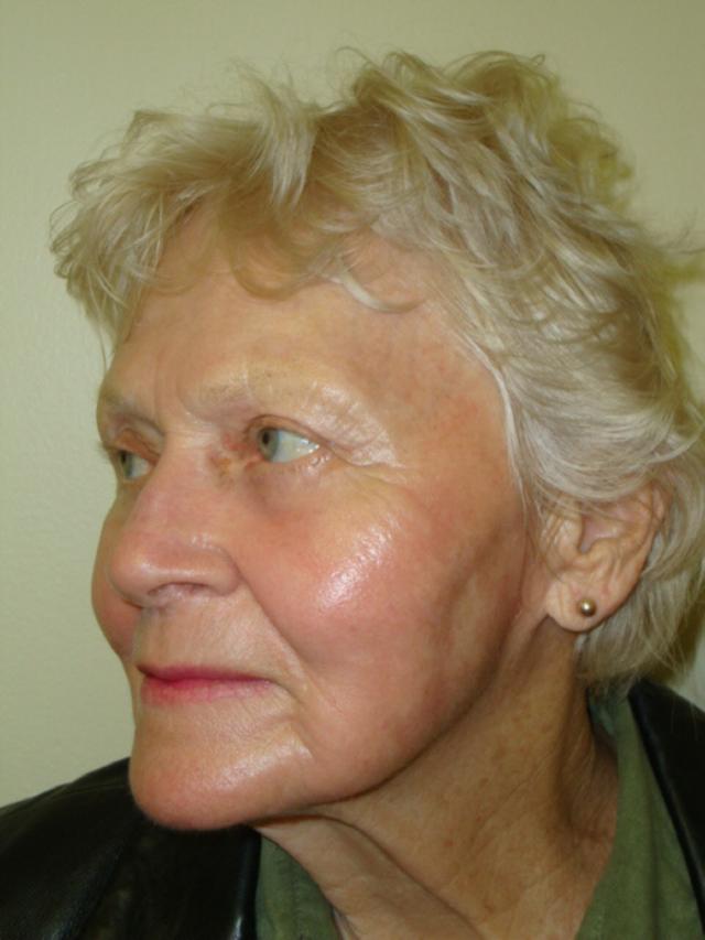Laser Skin Resurfacing after at Providence Facial Plastic and Cosmetic Surgery in Concordville, PA
