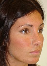 Providence Facial Plastic and Cosmetic Surgery rhinoplasty after — Concordville, PA