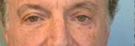 Providence Facial Plastic and Cosmetic Surgery eyelid lift after — Concordville, PA