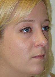 Providence Facial Plastic and Cosmetic Surgery rhinoplasty after — Concordville, PA