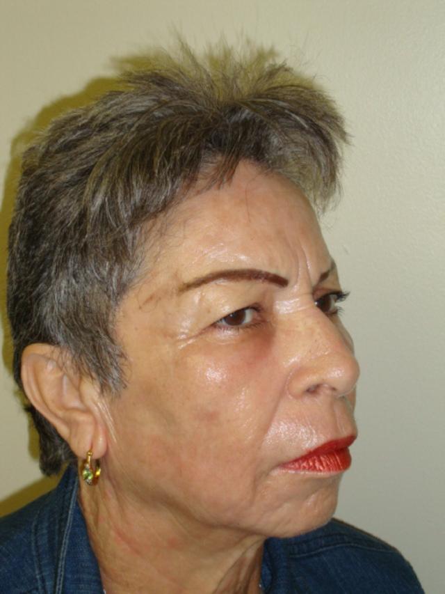 Microneedling after at Providence Facial Plastic and Cosmetic Surgery in Concordville, PA