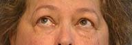 Blepharoplasty before at Providence Facial Plastic and Cosmetic Surgery in Concordville, PA