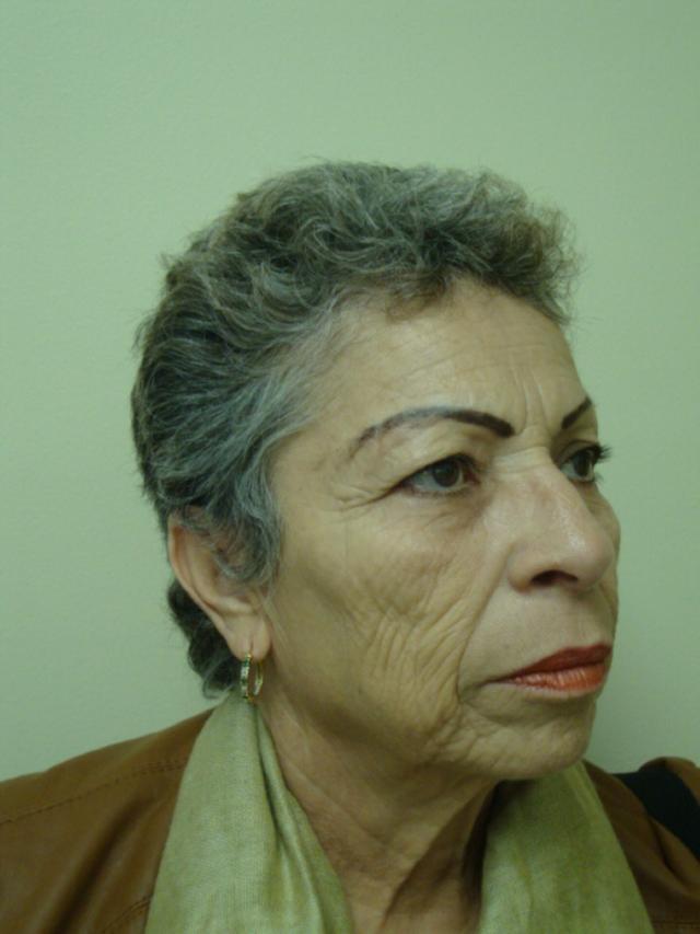 Microneedling before at Providence Facial Plastic and Cosmetic Surgery in Concordville, PA