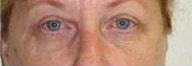 Providence Facial Plastic and Cosmetic Surgery eyelid lift after — Concordville, PA