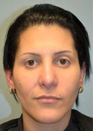Providence Facial Plastic and Cosmetic Surgery rhinoplasty after — Concordville, PA