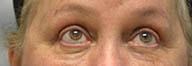 Providence Facial Plastic and Cosmetic Surgery eyelid lift after — Concordville, PA