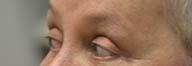 Providence Facial Plastic and Cosmetic Surgery eyelid lift after — Concordville, PA