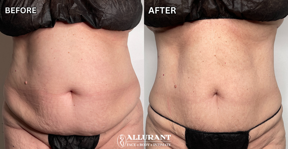 Allurant Medical Spa result — San Diego, CA