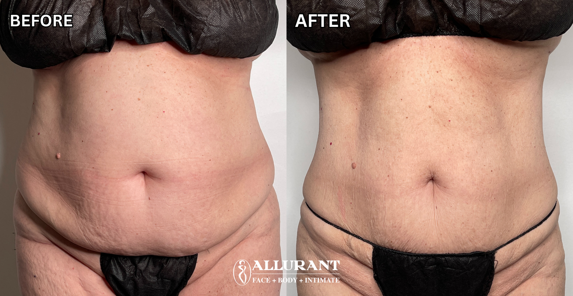 Allurant Medical Spa result — San Diego, CA