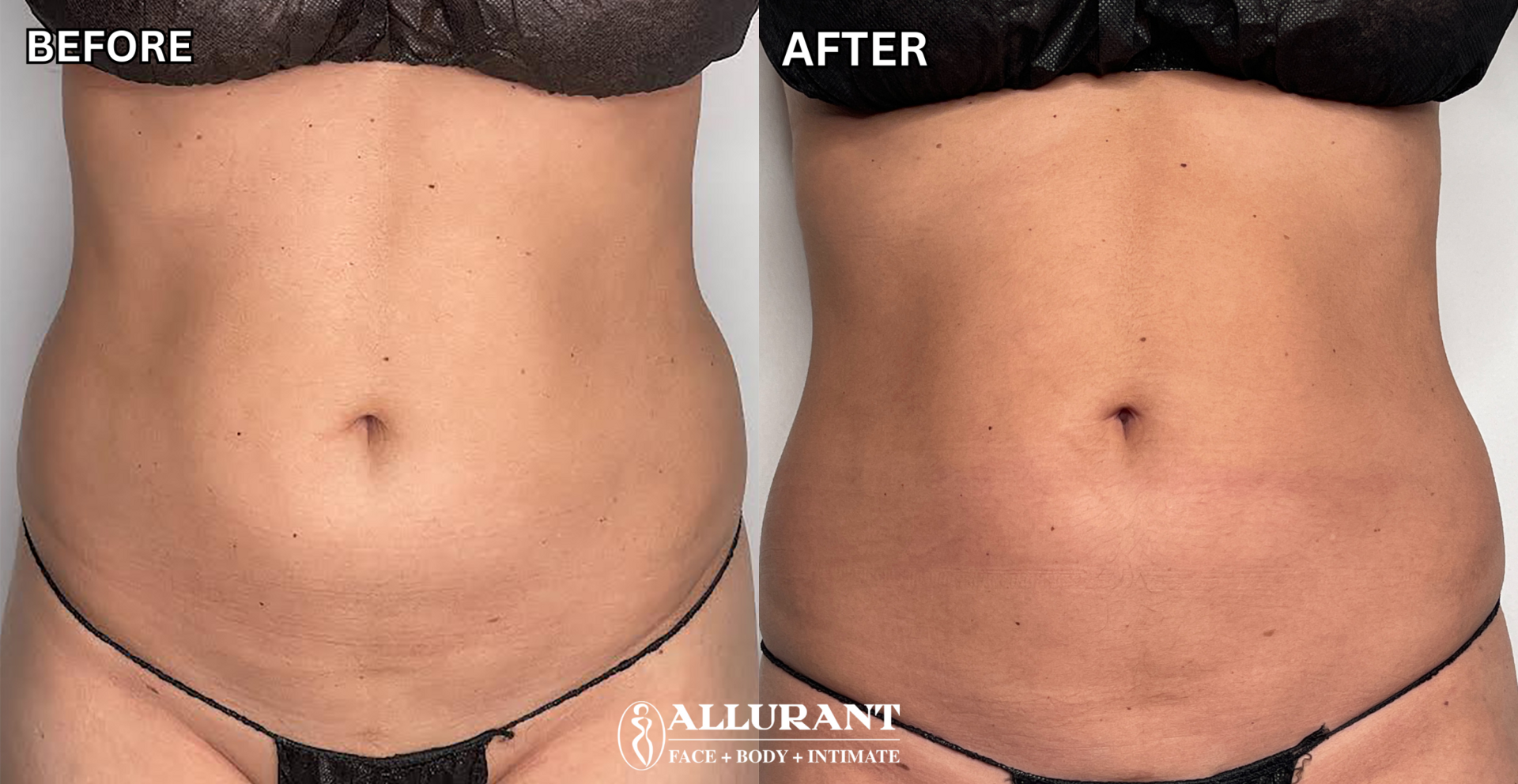 Allurant Medical Spa result — San Diego, CA