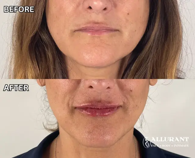 Lip Filler result at Allurant Medical Spa in San Diego, CA