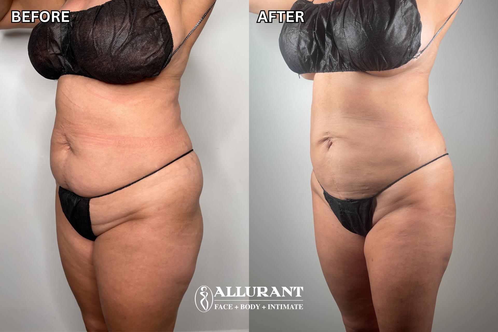 Allurant Medical Spa body contouring result — San Diego, CA