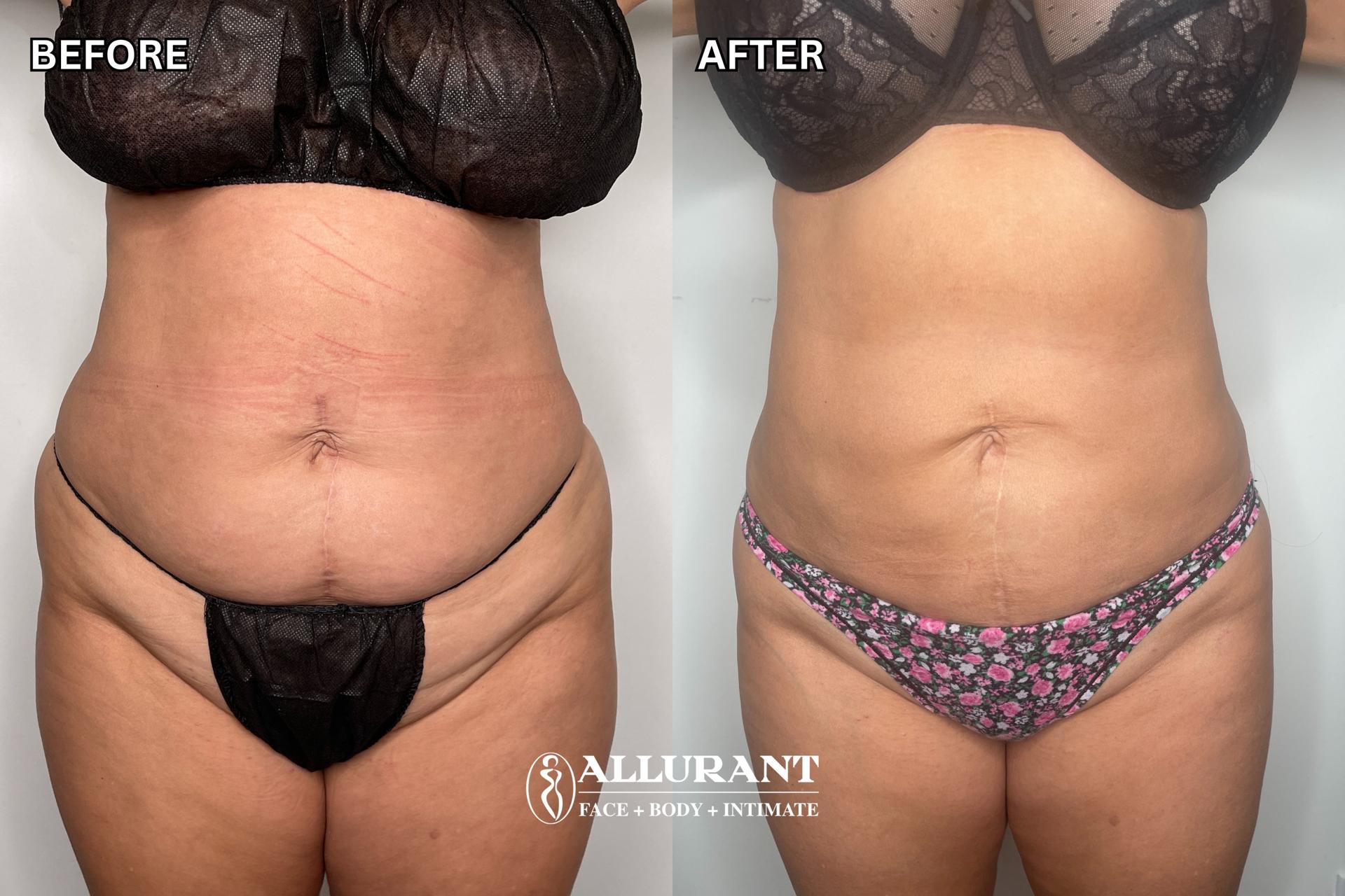 Allurant Medical Spa body contouring result — San Diego, CA